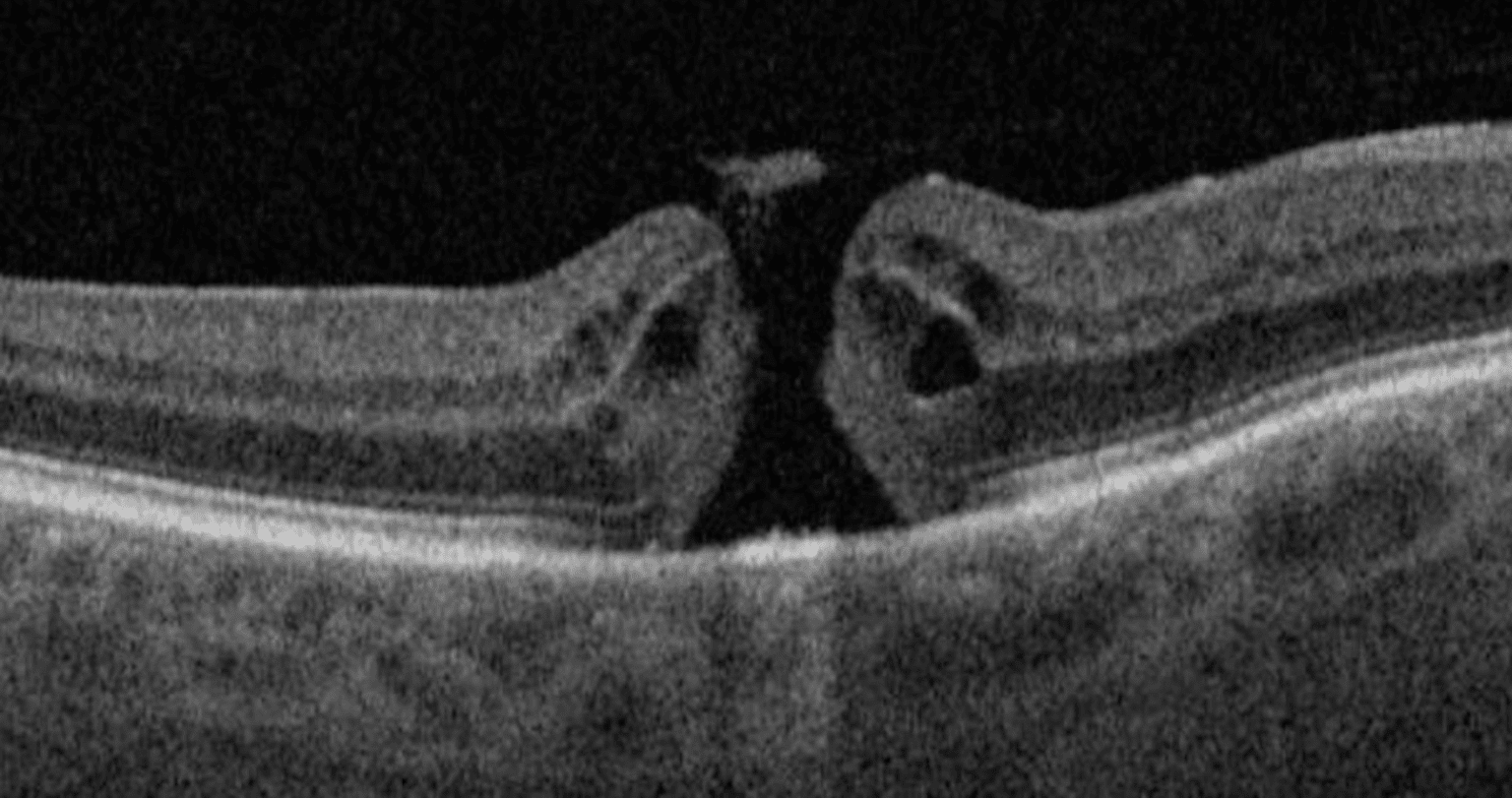 Macular Hole I Mr Ellabban Eye Surgery Yorkshire & Hull