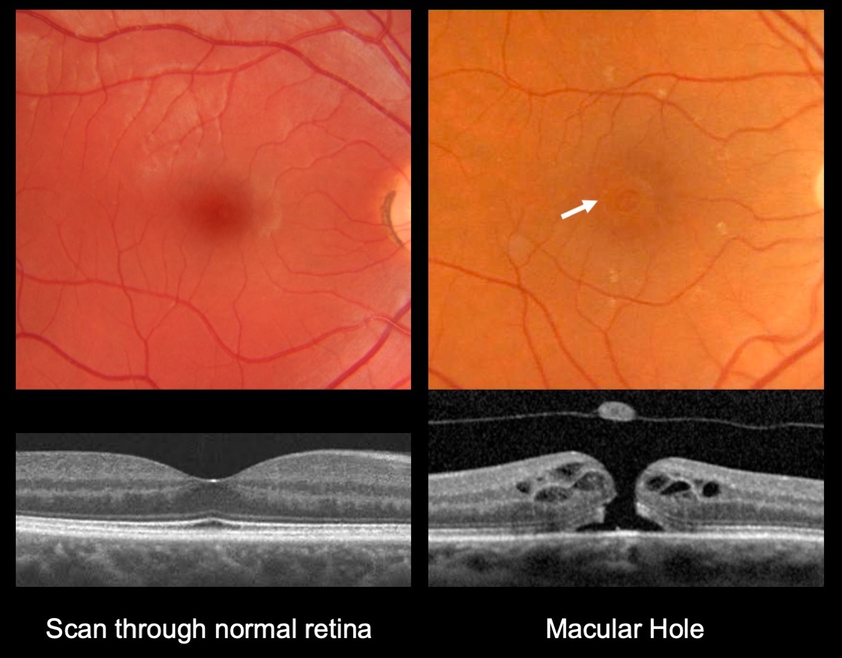 When Is It Too Late To Treat A Macular Hole Macular Hole I Mr Ellabban Eye Surgery | Yorkshire & Hull