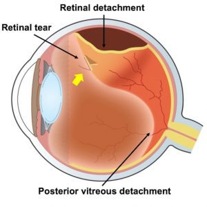 retinal detachment I Mr Ellabban