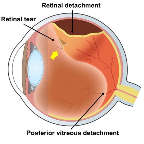 retinal detachment