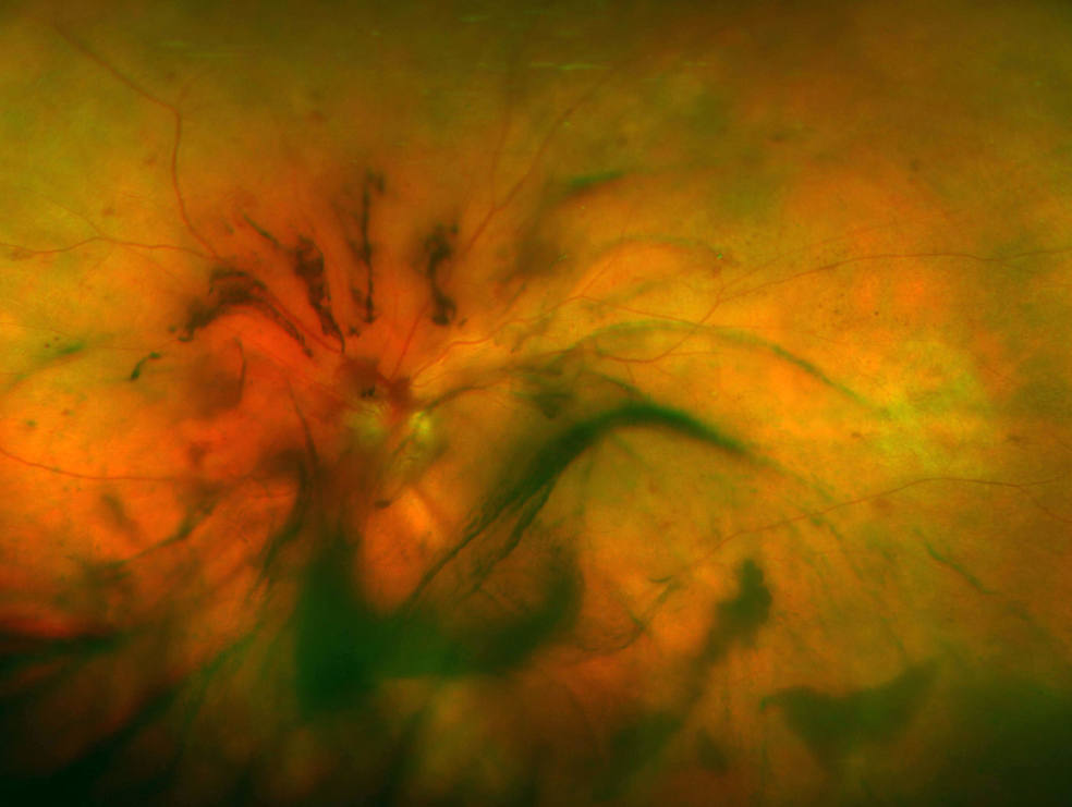 Diabetic Retinopathy Mr Ellabban Eye Surgery Yorkshire & Hull