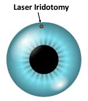 Laser iridotomy I Mr Ellabban