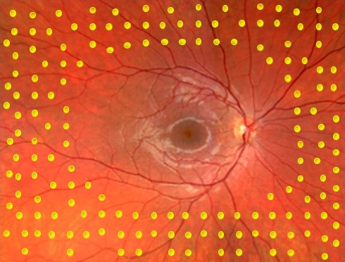 retinal laser I Mr Ellabban