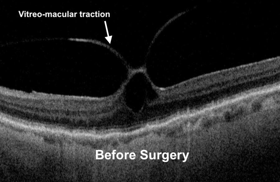 Vitreomacular Traction I Mr Ellabban Eye Surgery Yorkshire & Hull