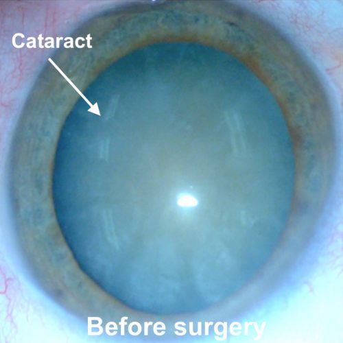 Cataract 2