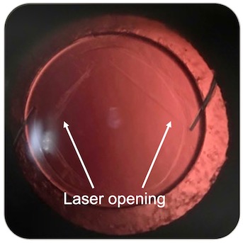 YAG Laser capsuolotomy for Posterior capsular opacification