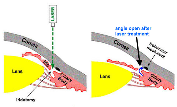 YAG Laser Iridotomy | Mr Ellabban