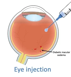 Diabetic macular oedema | Mr Ellabban