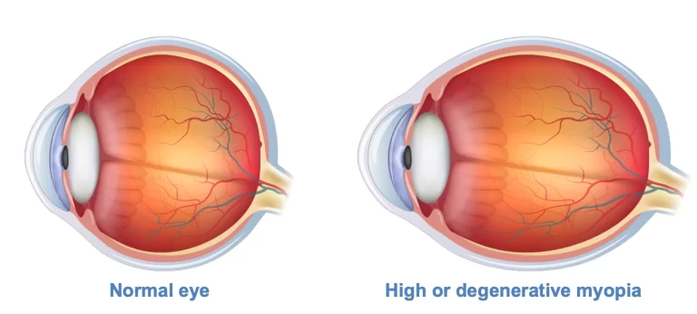 Normal eye vs high myopia | Mr Ellabban
