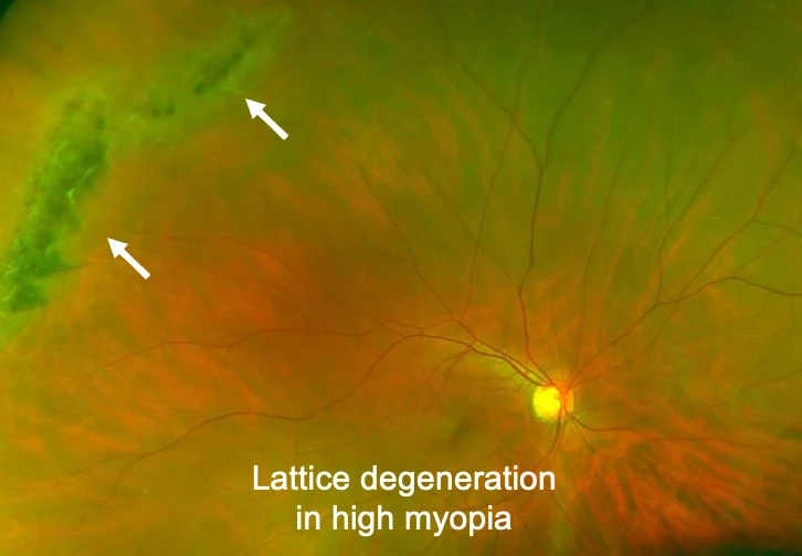 Lattice degeneration in high myopia | Mr Ellabban