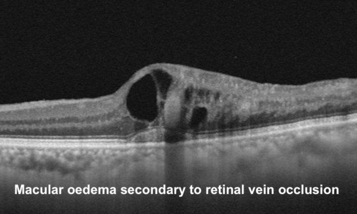 Retinal Vein Occlusion | Mr Ellabban