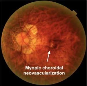 Myopic choroidal neovascularisation | Mr Ellabban