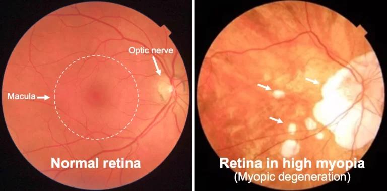 Normal retina vs High myopia | Mr Ellabban
