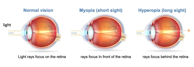 Myopia vs hyperopia | Mr Ellabban