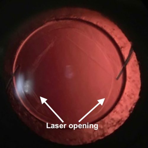 YAG Laser capsulotomy I Mr Ellabban Yorkshire & Hull