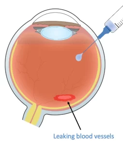 Eye Injections | Mr Ellabban