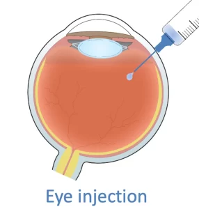 Eye Injection | Mr Ellabban