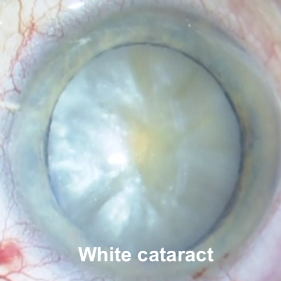 Cataract Surgery | Mr Ellabban