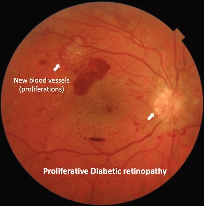 Proliferative diabetic retinopathy | Mr Ellabban