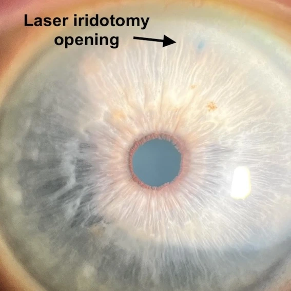 Laser iridotomy | Mr Ellabban
