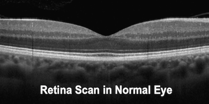 Mr Ellabban | Normal retina OCT scan